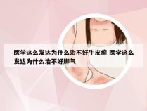 医学这么发达为什么治不好牛皮癣 医学这么发达为什么治不好脚气