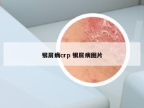 银屑病crp 银屑病图片