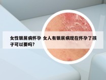 女性银屑病怀孕 女人有银屑病现在怀孕了孩子可以要吗?