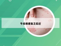 牛皮癣康复之后还