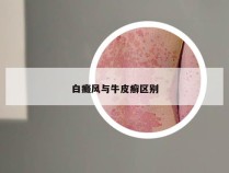 白癜风与牛皮癣区别