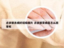 点状银肖病好结痂图片 点状银霄病是怎么回事呢