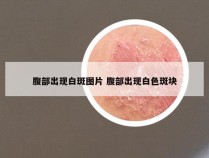 腹部出现白斑图片 腹部出现白色斑块