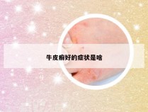 牛皮癣好的症状是啥