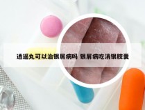 逍遥丸可以治银屑病吗 银屑病吃消银胶囊