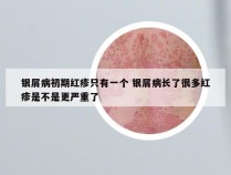 银屑病初期红疹只有一个 银屑病长了很多红疹是不是更严重了
