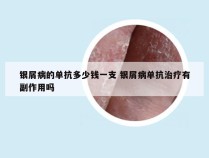银屑病的单抗多少钱一支 银屑病单抗治疗有副作用吗
