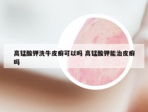 高锰酸钾洗牛皮癣可以吗 高锰酸钾能治皮癣吗