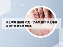 头上有牛皮癣几天洗一次头发最好 头上牛皮廨治疗需要多久才能好