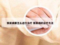 银屑病要怎么进行治疗 银屑病的冶疗方法