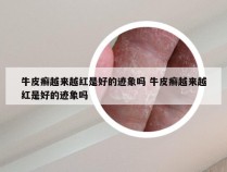 牛皮癣越来越红是好的迹象吗 牛皮癣越来越红是好的迹象吗