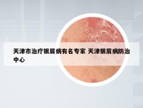 天津市治疗银屑病有名专家 天津银屑病防治中心