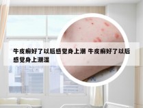 牛皮癣好了以后感觉身上潮 牛皮癣好了以后感觉身上潮湿