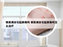 银屑病会引起脚臭吗 银屑病会引起脚臭吗怎么治疗