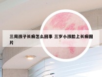 三周孩子长癣怎么回事 三岁小孩脸上长癣图片