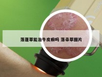 落蓬草能治牛皮癣吗 落帚草图片