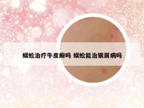 蜈蚣治疗牛皮癣吗 蜈蚣能治银屑病吗