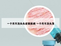 一个月不洗头头皮银屑病 一个月不洗头发