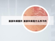 面部长癣图片 面部长癣是什么样子的