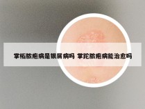 掌柘脓疱病是银屑病吗 掌跎脓疱病能治愈吗