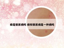 癣是银屑病吗 癣和银屑病是一种病吗
