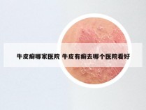 牛皮癣哪家医院 牛皮有癣去哪个医院看好