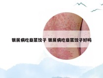 银屑病吃韭菜饺子 银屑病吃韭菜饺子好吗