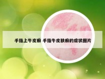 手指上牛皮癣 手指牛皮肤癣的症状图片