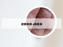 波银屑病 a银屑病