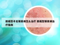脓疱型手足银屑病怎么治疗 脓疱型银屑病治疗指南