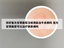 你好复方甘草酸苷注射液能治牛皮癣吗 复方甘草酸苷可以治疗银屑病吗