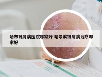 哈市银屑病医院哪家好 哈尔滨银屑病治疗哪家好