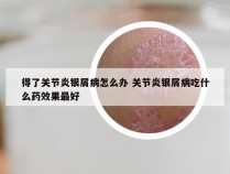 得了关节炎银屑病怎么办 关节炎银屑病吃什么药效果最好