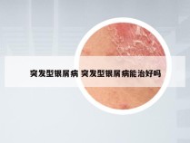 突发型银屑病 突发型银屑病能治好吗