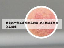 腿上起一些红皮癣怎么回事 腿上起红皮屑是怎么回事