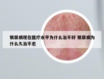 银屑病现在医疗水平为什么治不好 银屑病为什么久治不愈