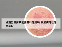 点滴型银屑病能用艾叶泡脚吗 银屑病可以泡艾草吗