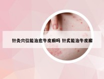 针灸穴位能治愈牛皮癣吗 针炙能治牛皮廨