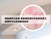 银屑病可以投保 银屑病投保时没告知有其它疾病时可以投保重疾险吗
