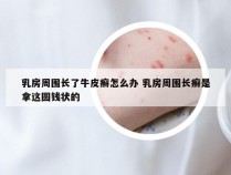 乳房周围长了牛皮癣怎么办 乳房周围长癣是拿这圆钱状的