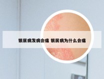 银屑病发病会痛 银屑病为什么会痛