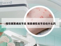 慢性银屑病关节炎 银屑病性关节炎吃什么药