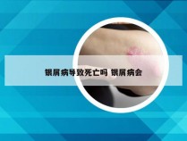 银屑病导致死亡吗 银屑病会