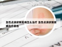 急性点滴状银屑病怎么治疗 急性点滴状银屑病治疗首选
