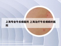 上海专业牛皮癣医院 上海治疗牛皮病癣的医院