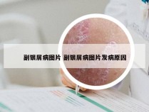 副银屑病图片 副银屑病图片发病原因