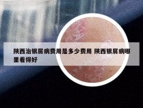 陕西治银屑病费用是多少费用 陕西银屑病哪里看得好