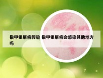 指甲银屑病传染 指甲银屑病会感染其他地方吗