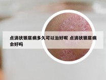 点滴状银屑病多久可以治好呢 点滴状银屑病会好吗