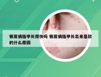 银屑病指甲长得快吗 银屑病指甲长出来是软的什么原因